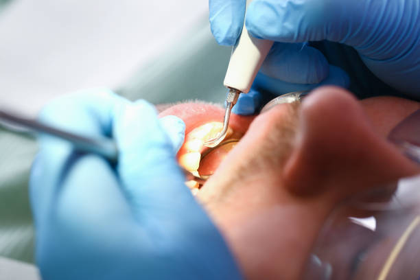 Best Emergency Dentist for Lost Fillings or Crowns in Hamilton, MO