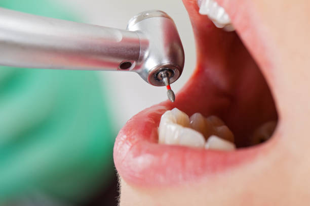 Best Emergency Dental Extractions in Hamilton, MO